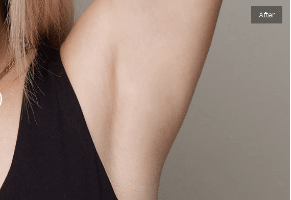 After Armpit Hair Removal with Ulike Air 10