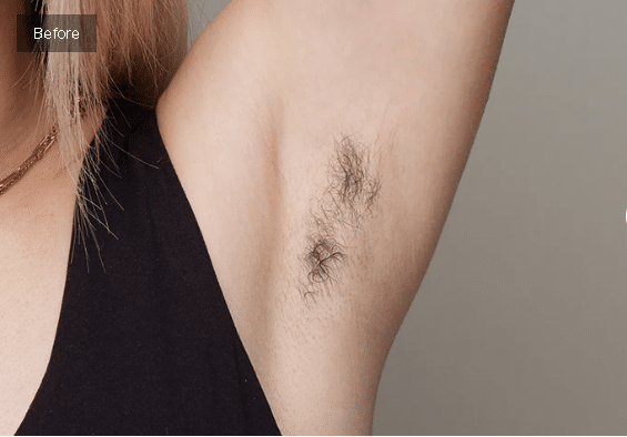 Before Armpit Hair Removal with Ulike Air 10