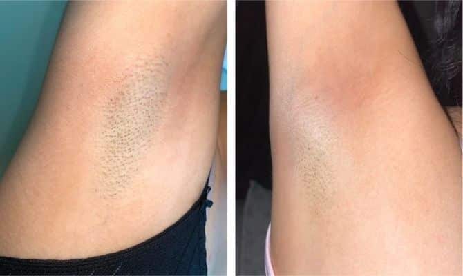 ulike armpits before after results