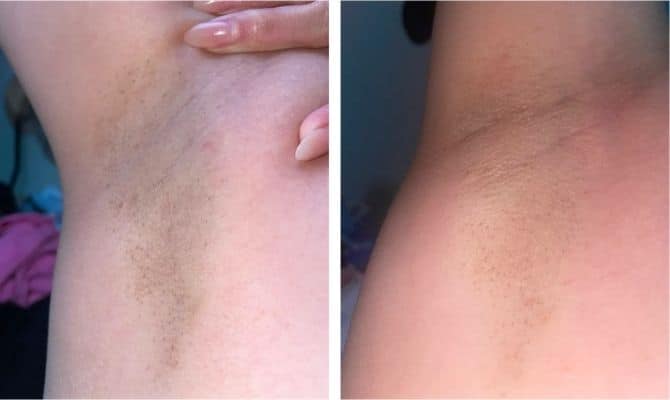 ulike armpits before after results