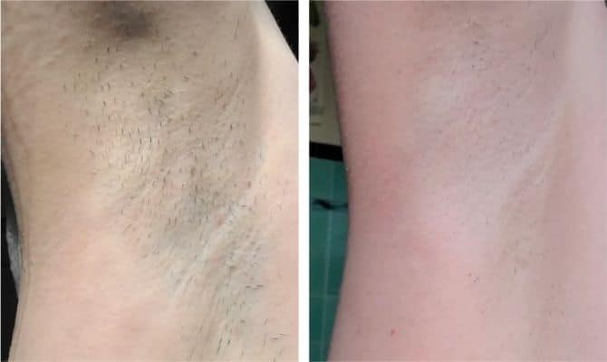 ulike armpits before after results