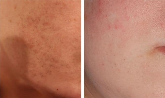 ulike face before after results