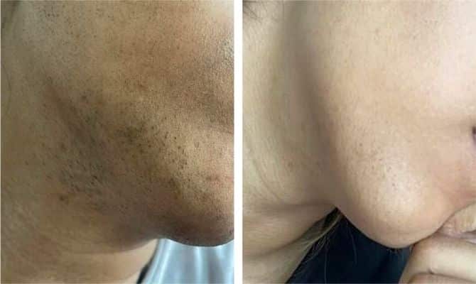 ulike face before after results