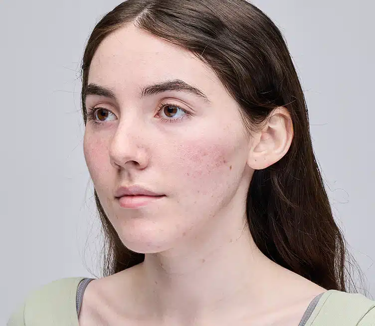Before Skin Treatment with Ulike ReGlow Face Mask