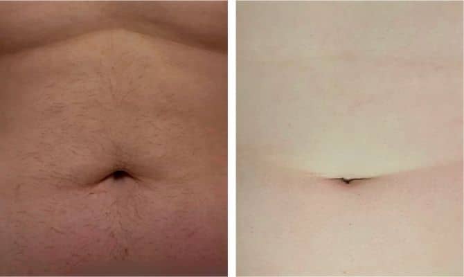 ulike stomach before after  results